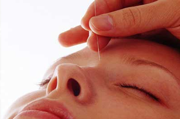 醒脑开窍”针刺法
