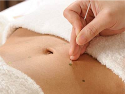 针灸埋线